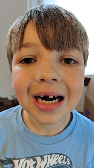 Andrew Lost a Tooth